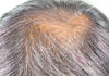 greying hair baldness cure follicle shaft