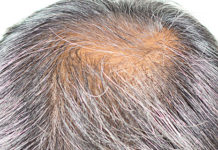 Calvicie y cabello canoso encanecimiento del cabello calvicie curar eje del folículo