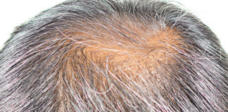 encanecimiento del cabello calvicie curar eje del folículo