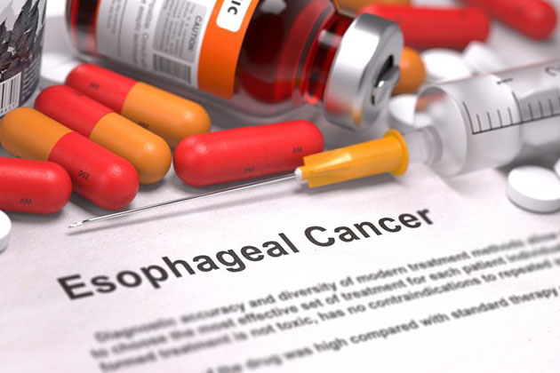Risque de cancers de l'œsophage prévenir