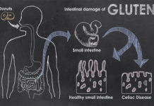 Непереносимость глютена: многообещающий шаг к разработке лечения муковисцидоза и целиакии непереносимость глютена муковисцидоз белок CFTR целиакия