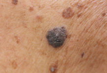 Baktheria e Letlalong le Phelang e ka Thibela Kankere ea Letlalo kankere ea letlalo libaktheria thibelo bophelo bo botle