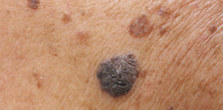 prevenzione dei batteri del cancro della pelle sana