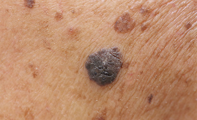 skin cancer bacteria prevention healthy