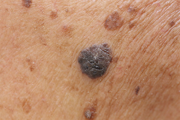 cáncer de piel bacterias prevención saludable
