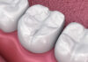 Matériau de remplissage de carie dentaire composite antibactérien