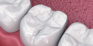 Material de relleno de caries dental compuesto antibacteriano