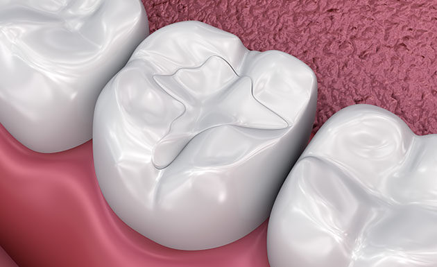 Materiale di riempimento per carie dentaria composito antibatterico