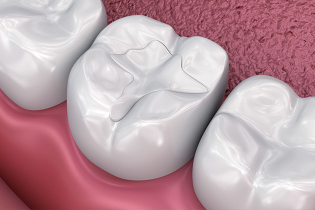 Materiale di riempimento per carie dentaria composito antibatterico