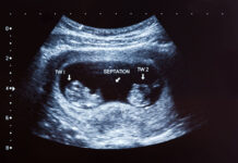 సెస్క్విజైగోటిక్ (సెమీ-ఐడెంటికల్) కవలలను అర్థం చేసుకోవడం: రెండవది, గతంలో నివేదించని కవలల రకం సెస్క్విజైగోటిక్ సెమీ-ఇడెంటికల్ ట్విన్స్ ట్విన్నింగ్ డిస్పెర్మిక్ ఫెర్టిలైజేషన్ చిమెరాస్