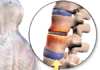 Боль в спине: белок Ccn2a обратил дегенерацию межпозвонкового диска (МПД) в животной модели