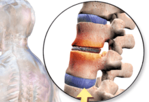 כאבי גב: ניוון Ccn2a חלבון הפוך של דיסק בין חולייתי (IVD) במודל של בעלי חיים