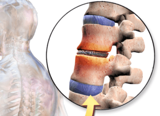 Back pain: Ccn2a protein reversed Intervertebral disc (IVD) degeneration in animal model
