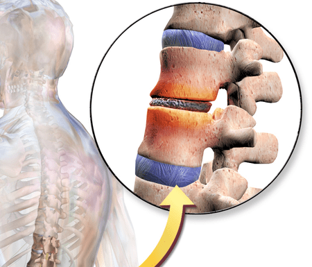 Back pain: Ccn2a protein reversed Intervertebral disc (IVD) degeneration in animal model