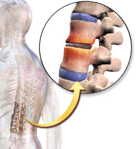Боль в спине: белок Ccn2a обратил дегенерацию межпозвонкового диска (МПД) в животной модели