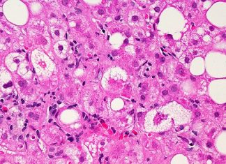 Rezdiffra（resmetirom）： FDA 批准首个治疗脂肪肝引起的肝脏疤痕的药物