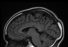超高场 (UHF) 人体 MRI：使用 Iseult 项目的 11.7 特斯拉 MRI 成像的活体大脑