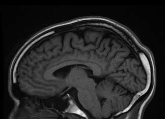 MRI umana a campi ultra-alti (UHF): cervello vivente ripreso con MRI da 11.7 Tesla del progetto Iseult