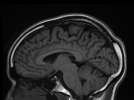Ultra-High Fields (UHF) Menselijke MRI: Living Brain afgebeeld met 11.7 Tesla MRI van Iseult Project