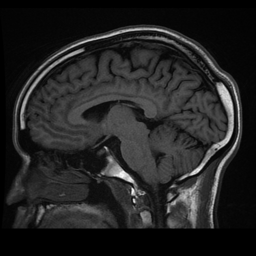 超高磁場 (UHF) 人間の MRI: イゾルト プロジェクトの 11.7 テスラ MRI で撮影された生きた脳