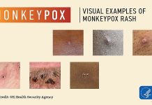 වඳුරු පොක්ස් (Mpox) පැතිරීම ජාත්යන්තර සැලකිල්ලේ මහජන සෞඛ්ය හදිසි අවස්ථාවක් ලෙස ප්රකාශයට පත් කරන ලදී WHO විසින් වඳුරු පොක්ස් (Mpox) පැතිරීම ජාත්යන්තර සැලකිල්ලේ (PHEIC) මහජන සෞඛ්ය හදිසි අවස්ථාවක් ලෙස ප්රකාශයට පත් කරන ලදී