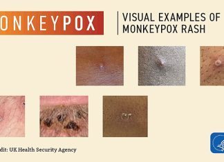 Brote de viruela simica (Mpox) declarado emergencia de salud pública de importancia internacional Brote de viruela simica (Mpox) declarado emergencia de salud pública de importancia internacional (ESPII) por la OMS