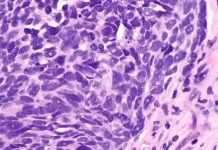 Erster britischer Lungenkrebspatient erhält mRNA-Impfstoff BNT116 Erster britischer Lungenkrebspatient erhält mRNA-Impfstoff BNT116