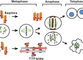 Терапия опухолевыми полями (TTFields) одобрена для лечения рака поджелудочной железы. Терапия опухолевыми полями (TTFields) одобрена для лечения рака поджелудочной железы.